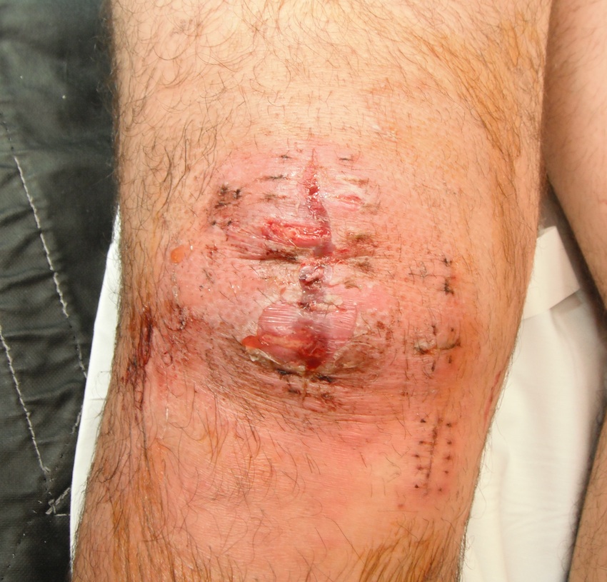 Infected ACL
